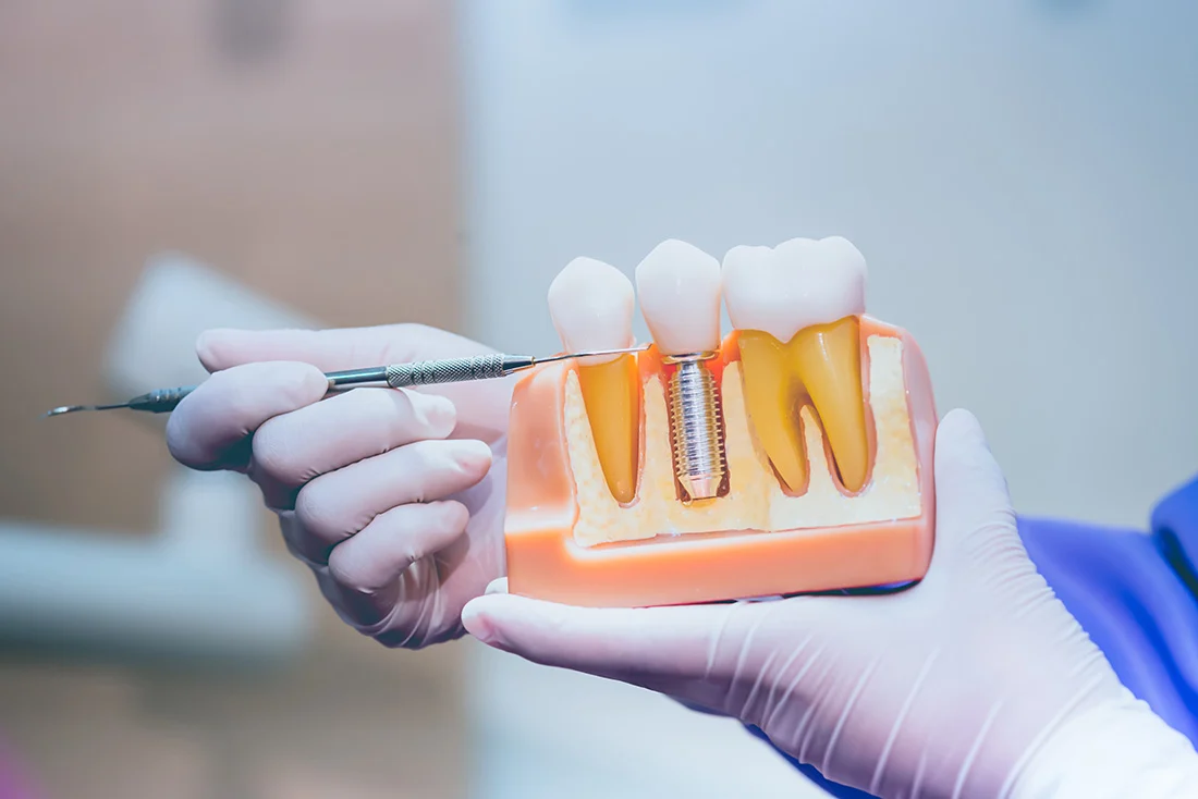 Affordable-Dental-Implants-Near-You-1