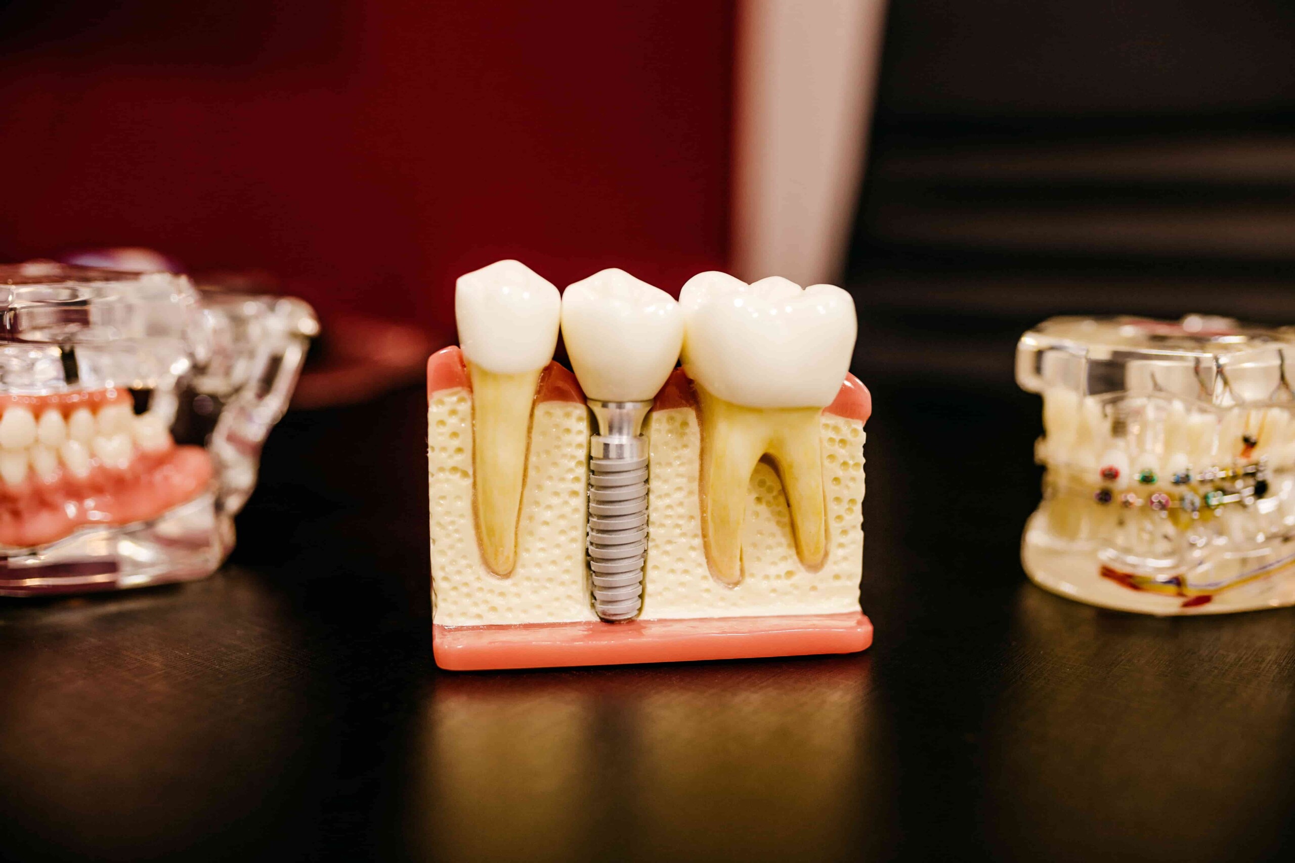 Affordable-Dental-Implants-Near-You-2